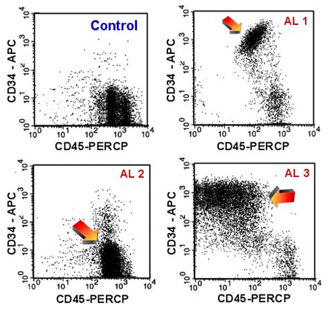 results leukemia/lymphoma panel by flow|Flow Cytometry: Test, Use, Analysis & Results .